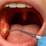 How to Make Tonsil Stones Fall Out— Safely and Effectively