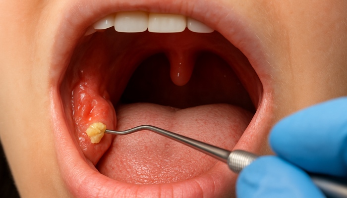 How to Make Tonsil Stones Fall Out— Safely and Effectively
