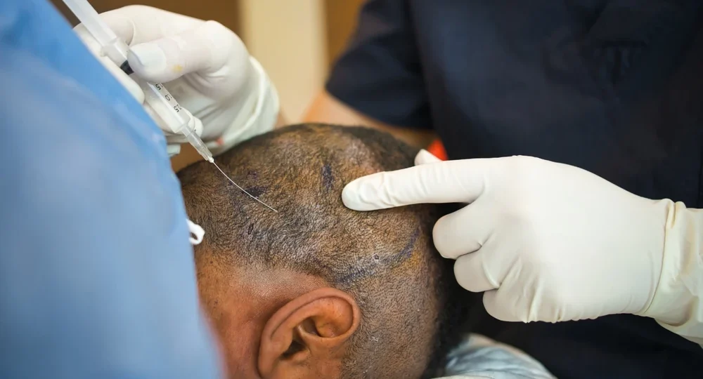 Best Hair Transplant Clinic in Chandigarh for Natural Results