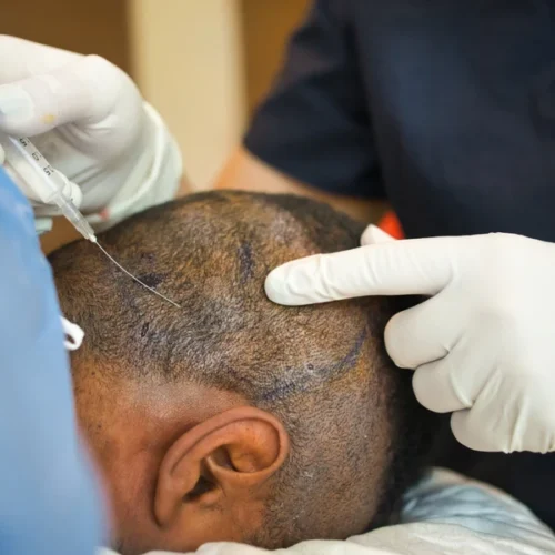 Best Hair Transplant Clinic in Chandigarh for Natural Results