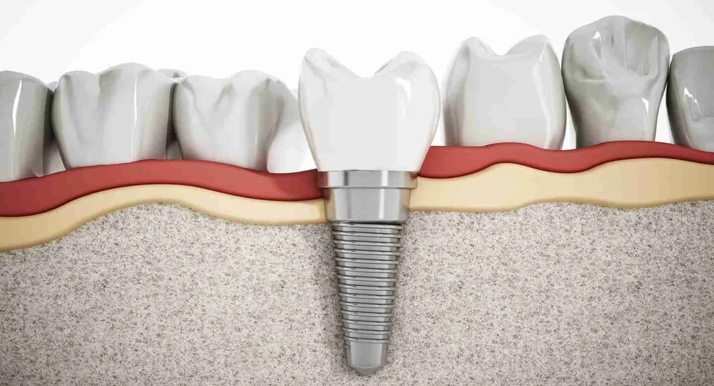 What Are Screwless Dental Implants? Sorting the Marketing From the Hardware, and What to Ask Stubbs Dental
