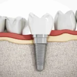 What Are Screwless Dental Implants? Sorting the Marketing From the Hardware, and What to Ask Stubbs Dental